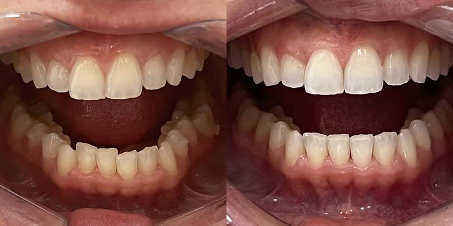 Dientes apiñados: antes y después del tratamiento con alineadores