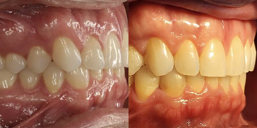 Problemas de mordida: antes y después del tratamiento con alineadores