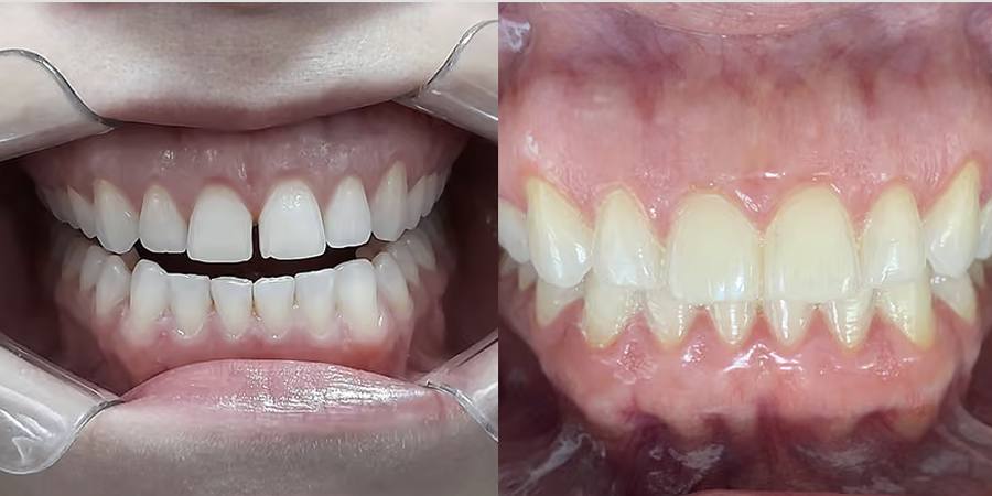 Dientes separados: antes y después del tratamiento con alineadores